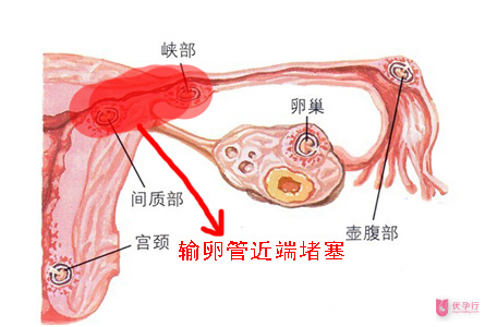輸卵管堵塞的相關(guān)知識，大多數(shù)人都不知道這個！